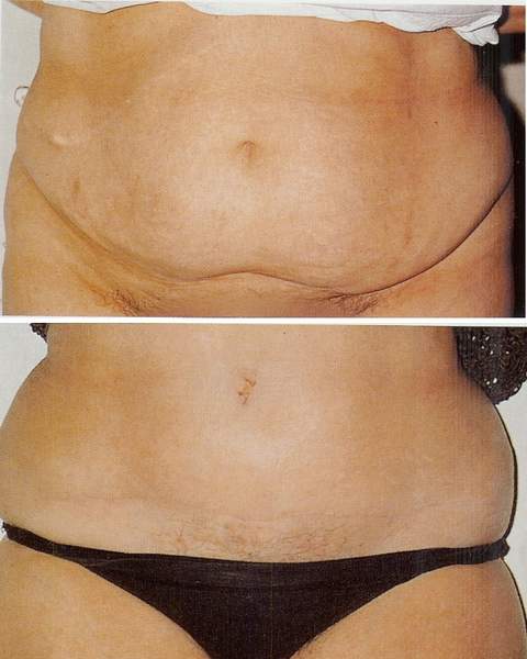 Abdominoplasty