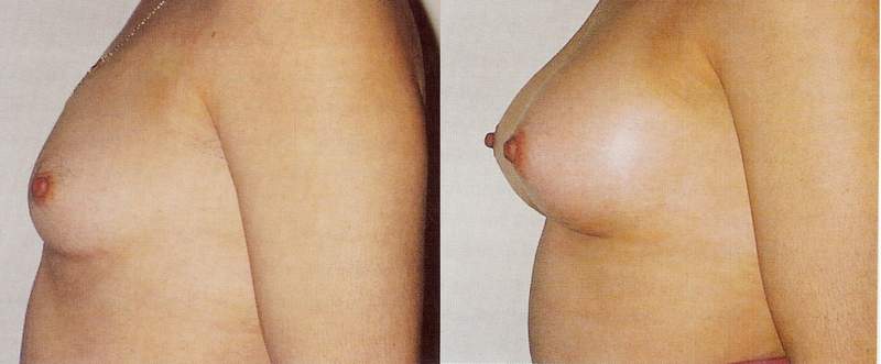 Breast enlargement