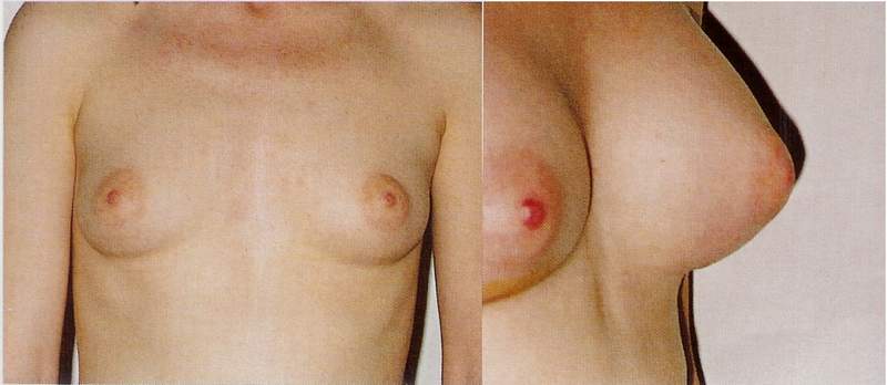 Breast enlargement
