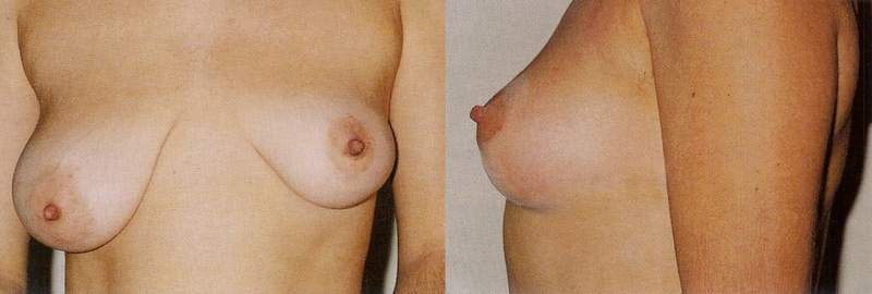 Breast lift