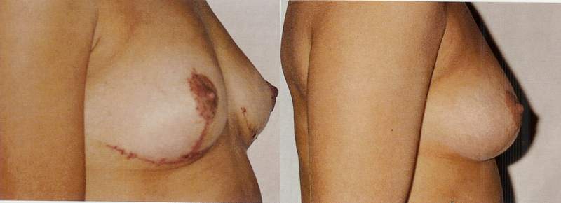 Breast lift