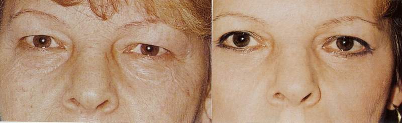Eye lid