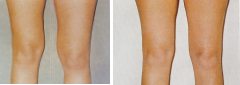 Liposuction