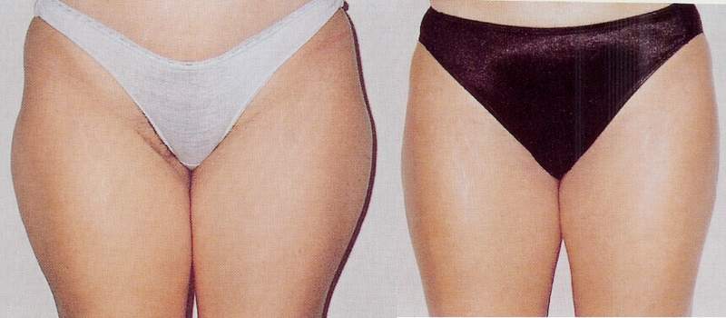 Liposuction