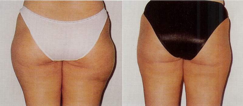 Liposuction