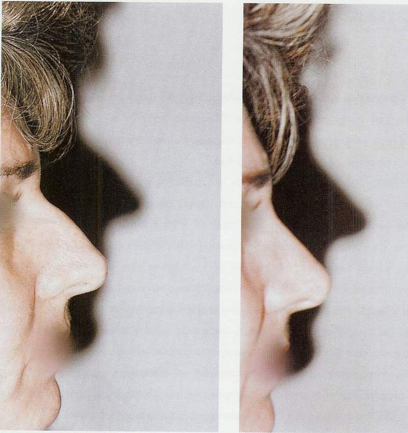 Rhinoplasty