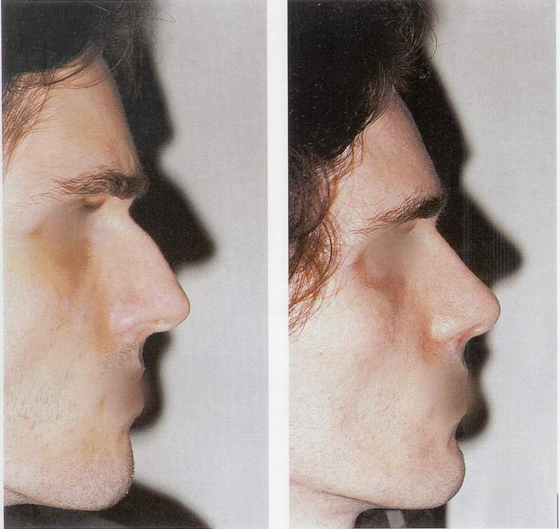 Rhinoplasty