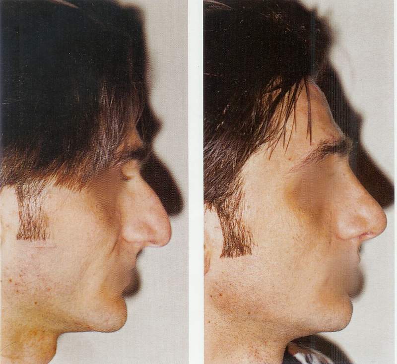 Rhinoplasty