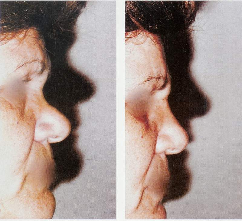 Rhinoplasty