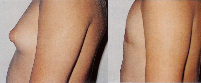 gynecomastya